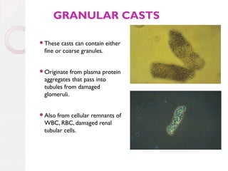 GRANULAR CASTS
These

casts can contain either
fine or coarse granules.

Originate

from plasma protein
aggregates that pass into
tubules from damaged
glomeruli.

Also

from cellular remnants of
WBC, RBC, damaged renal
tubular cells.

 