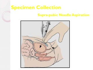 Specimen Collection
Supra-pubic Needle Aspiration

 