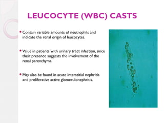 LEUCOCYTE (WBC) CASTS
Contain

variable amounts of neutrophils and
indicate the renal origin of leucocytes.

Value

in patients with urinary tract infection, since
their presence suggests the involvement of the
renal parenchyma.

May

also be found in acute interstitial nephritis
and proliferative active glomerulonephritis.

 