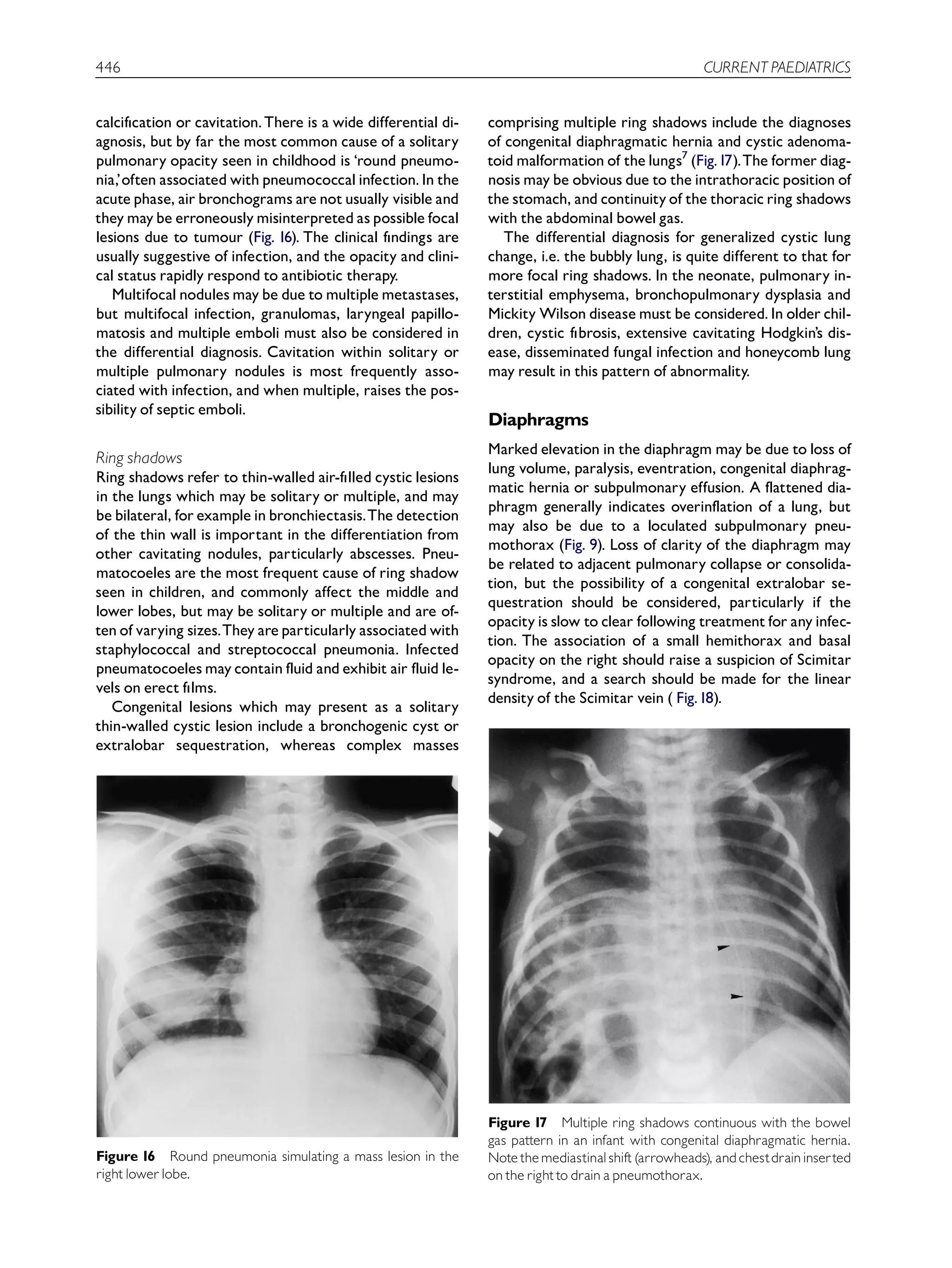 Opasity Examples Interpretation of the paediatric chest x-ray | PDF