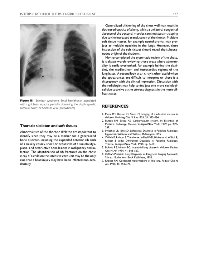 Interpretation of the paediatric chest xray