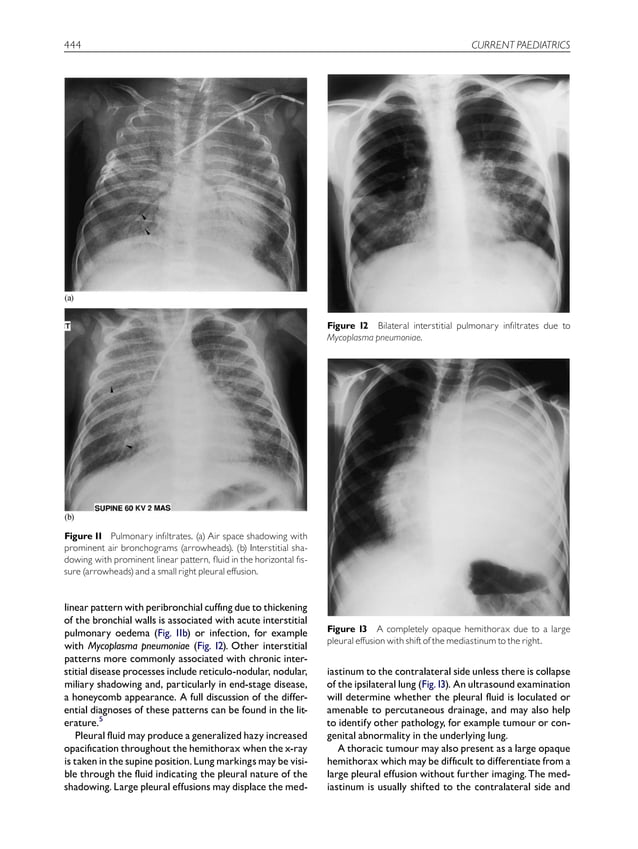 Interpretation of the paediatric chest xray