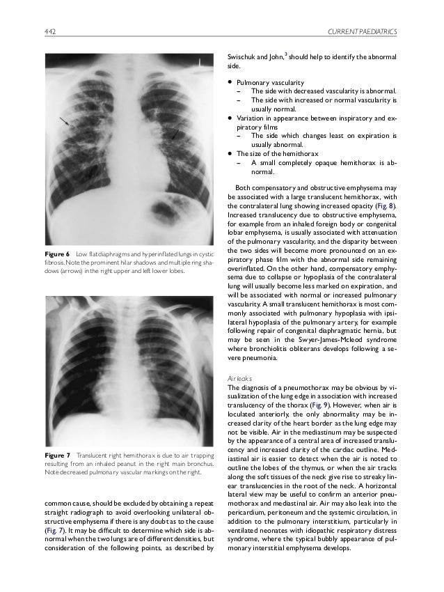 Interpretation of the paediatric chest xray