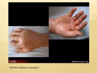 Arthrite septique du poignet.
 