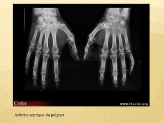 Arthrite septique du poignet.
 