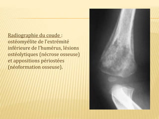 Radiographie du coude :
ostéomyélite de l’extrémité
inférieure de l’humérus, lésions
ostéolytiques (nécrose osseuse)
et appositions périostées
(néoformation osseuse).
 