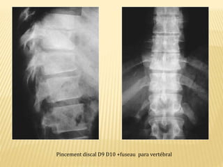 Pincement discal D9 D10 +fuseau para vertébral
 