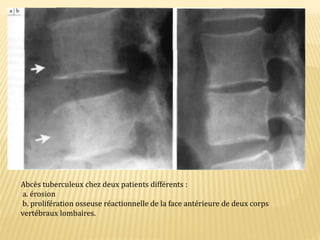 Abcès tuberculeux chez deux patients différents :
a. érosion
b. prolifération osseuse réactionnelle de la face antérieure de deux corps
vertébraux lombaires.
 