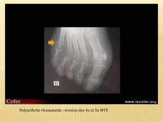 Polyarthrite rhumatoïde : érosion des 4e et 5e MTP.
 