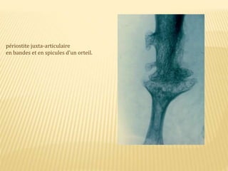 périostite juxta-articulaire
en bandes et en spicules d’un orteil.
 