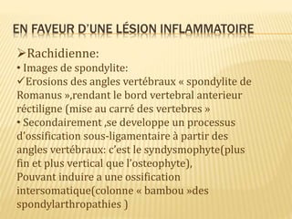 EN FAVEUR D’UNE LÉSION INFLAMMATOIRE
Rachidienne:
• Images de spondylite:
Erosions des angles vertébraux « spondylite de
Romanus »,rendant le bord vertebral anterieur
réctiligne (mise au carré des vertebres »
• Secondairement ,se developpe un processus
d’ossification sous-ligamentaire à partir des
angles vertébraux: c’est le syndysmophyte(plus
fin et plus vertical que l’osteophyte),
Pouvant induire a une ossification
intersomatique(colonne « bambou »des
spondylarthropathies )
 