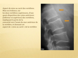 Aspect de mise au carré des vertèbres.
Mise en évidence, sur
les deux vertèbres supérieures, d’une
quasi-disparition des coins antérieurs
(inférieur et supérieur) des vertèbres,
impliquant la perte de la
concavité vers l’avant du mur antérieur de
la vertèbre, et donnant cet
aspect de « mise au carré » de la vertèbre
 