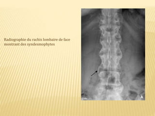 Radiographie du rachis lombaire de face
montrant des syndesmophytes
 