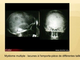 Myélome multiple : lacunes à l'emporte-pièce de différentes taille
 