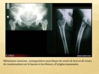 Métastases osseuses : juxtaposition anarchique de zones de lyse et de zones
de condensation sur le bassin et les fémurs, d'origine mammaire
 
