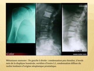 Métastases osseuses : De gauche à droite : condensation peu étendue, à bords
nets de la diaphyse humérale, vertèbre d'ivoire L1, condensation diffuse du
rachis lombaire d'origine néoplasique prostatique.
 
