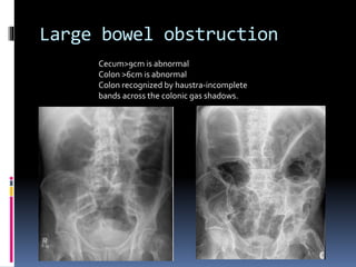 Interpret axr and imaging of gist system | PPTX