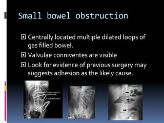 Valvulae Interpret axr and imaging of gist system | PPTX
