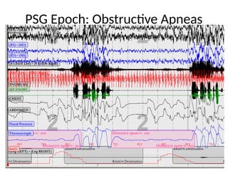 interpreting Sleep Studies primer (1).pptx