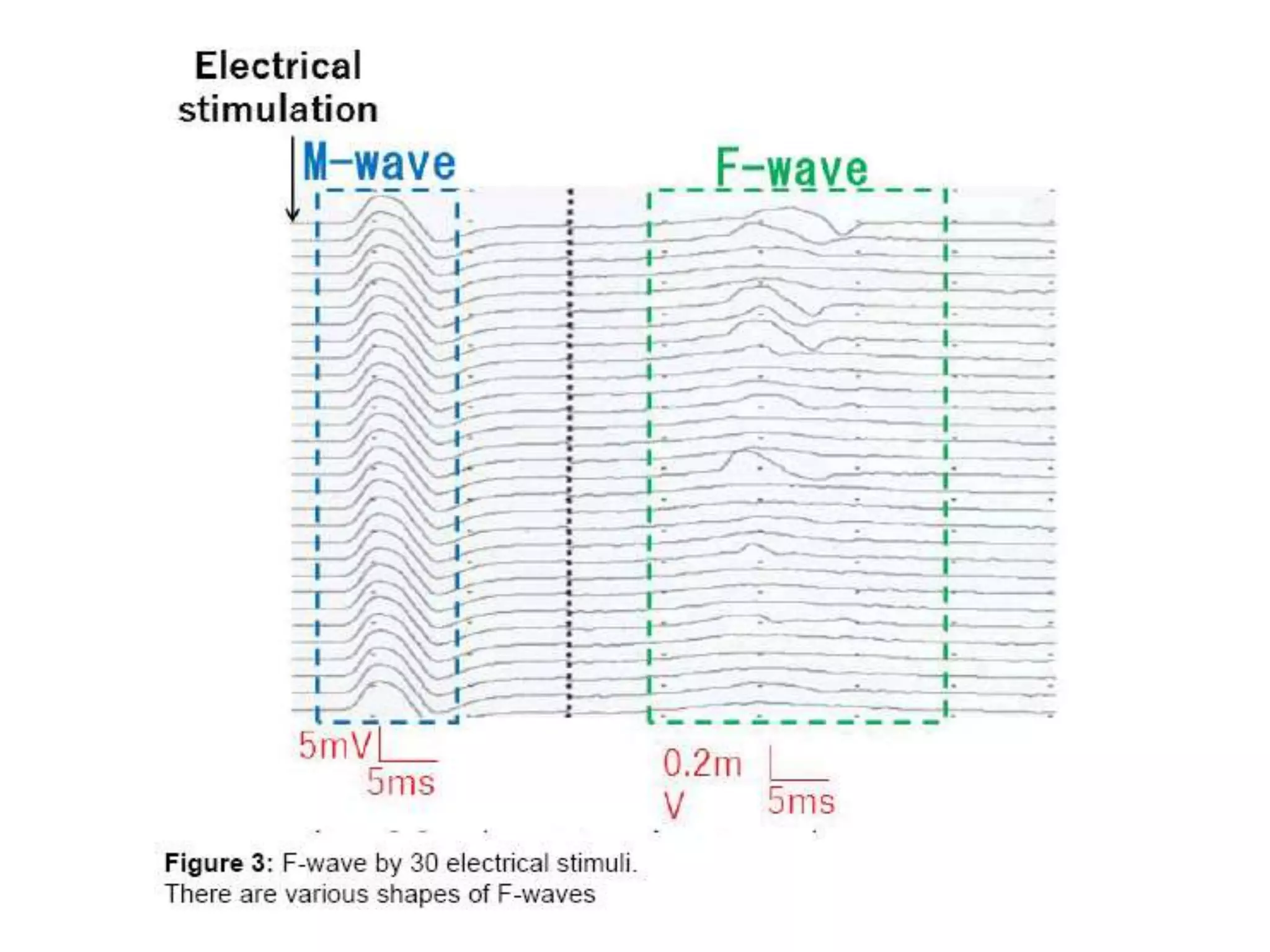 Interpretation of NCS and EMG | PPTX
