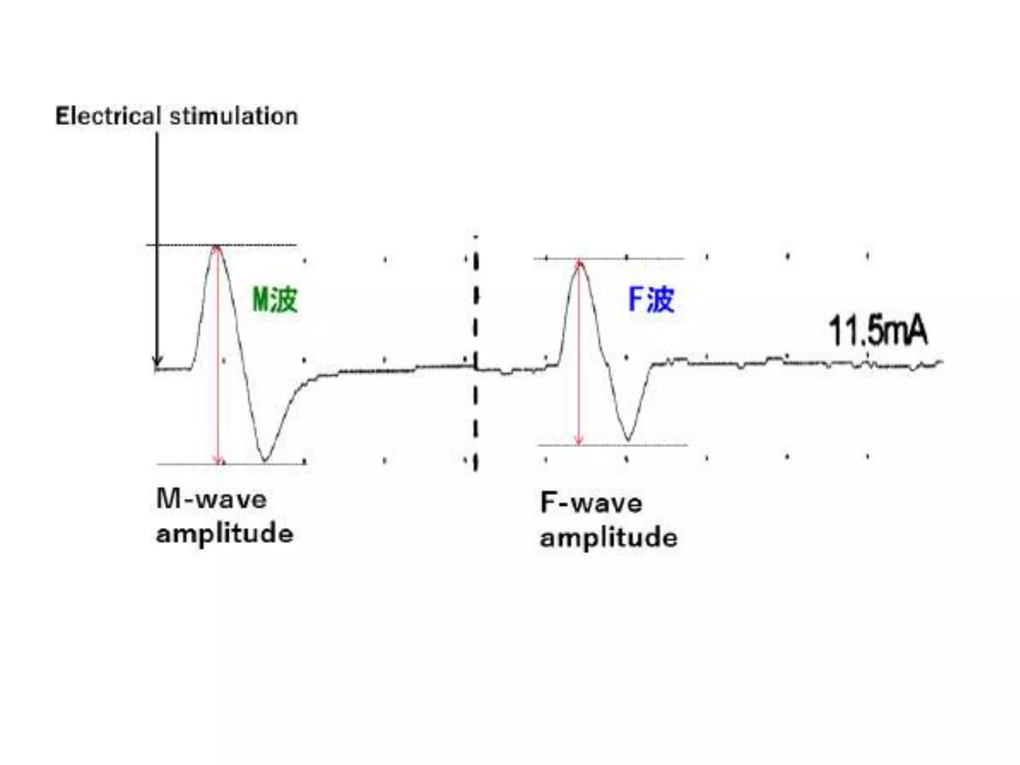 Interpretation of NCS and EMG | PPTX