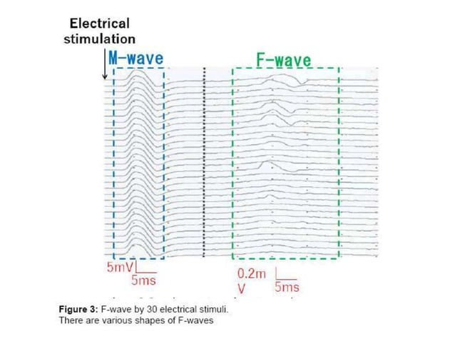 Interpretation of NCS and EMG | PPTX | Death, Injury, or Military ...