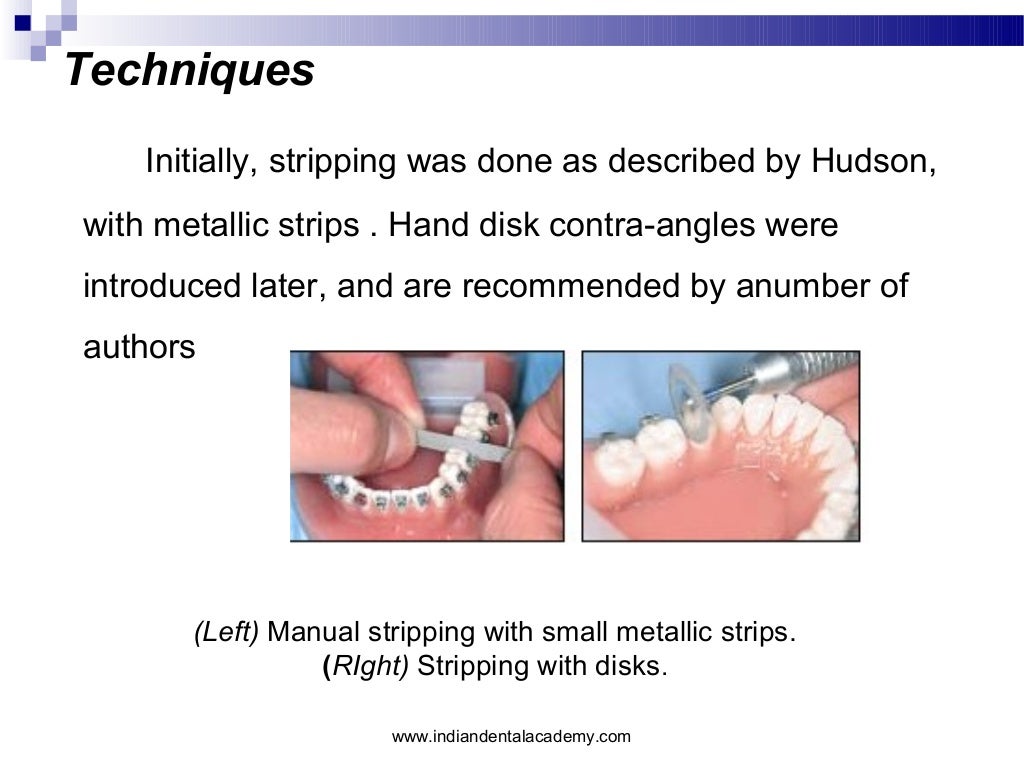 Interproximal enamel reduction