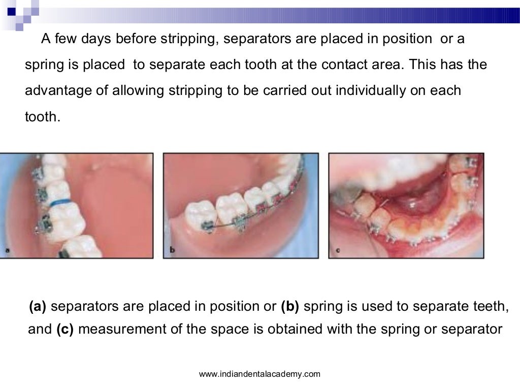 Interproximal enamel reduction