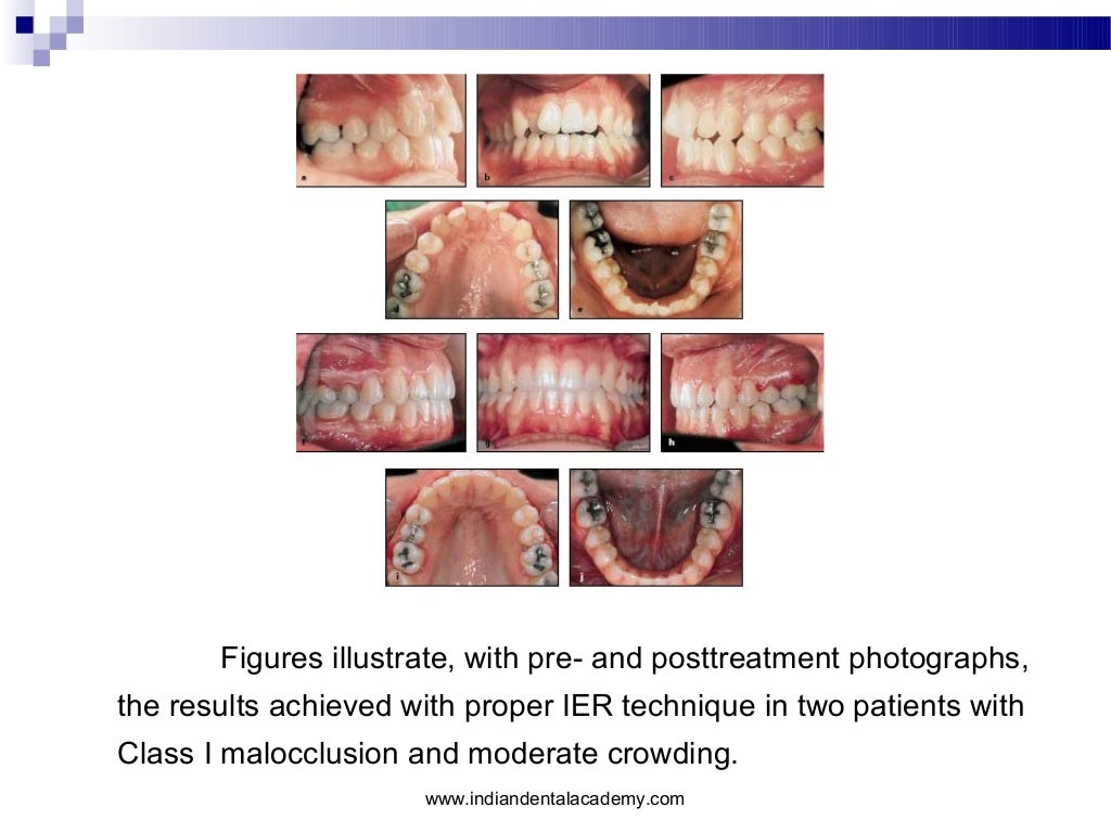 Interproximal enamel reduction