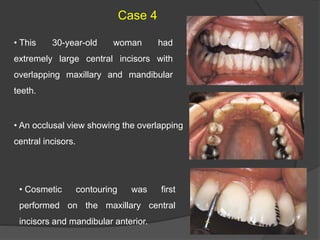• This 30-year-old woman had
extremely large central incisors with
overlapping maxillary and mandibular
teeth.
• An occlusal view showing the overlapping
central incisors.
• Cosmetic contouring was first
performed on the maxillary central
incisors and mandibular anterior.
Case 4
 