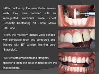 • After contouring the mandibular anterior
teeth, they were polished with an
impregnated aluminum oxide wheel
(Cosmetic Contouring Kit, Shofu, Menlo
Park, CA).
• Next, the maxillary laterals were bonded
with composite resin and contoured and
finished with ET carbide finishing burs
(Brasseler).
• Better tooth proportion and straighter
appearing teeth can be seen here before the
final polishing.
 