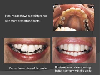 Final result shows a straighter arc
with more proportional teeth.
Pretreatment view of the smile. Post-treatment view showing
better harmony with the smile.
 