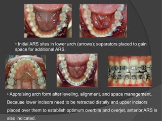 • Appraising arch form after leveling, alignment, and space management.
Because lower incisors need to be retracted distally and upper incisors
placed over them to establish optimum overbite and overjet, anterior ARS is
also indicated.
• Initial ARS sites in lower arch (arrows); separators placed to gain
space for additional ARS.
 