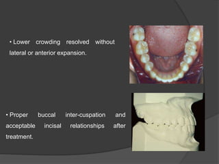• Proper buccal inter-cuspation and
acceptable incisal relationships after
treatment.
• Lower crowding resolved without
lateral or anterior expansion.
 