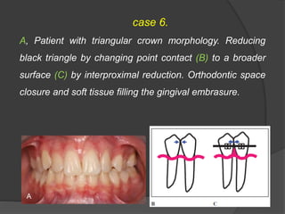 case 6.
A, Patient with triangular crown morphology. Reducing
black triangle by changing point contact (B) to a broader
surface (C) by interproximal reduction. Orthodontic space
closure and soft tissue filling the gingival embrasure.
A
 