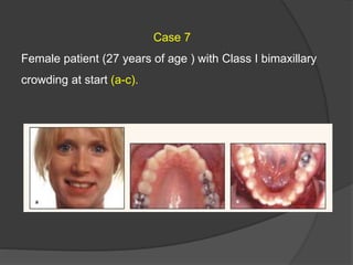 Case 7
Female patient (27 years of age ) with Class I bimaxillary
crowding at start (a-c).
 