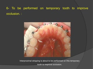 6- To be performed on temporary tooth to improve
occlusion. :
Interproximal stripping is about to be performed on this temporary
tooth to improve occlusion.
 