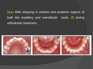 (d,e) After stripping in anterior and posterior regions of
both the maxillary and mandibular tooth. (f) during
orthodontic treatment.
 
