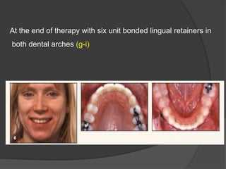 At the end of therapy with six unit bonded lingual retainers in
both dental arches (g-i)
 