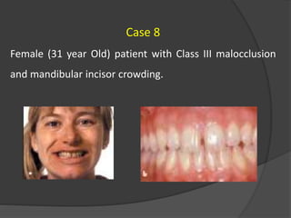Case 8
Female (31 year Old) patient with Class III malocclusion
and mandibular incisor crowding.
 