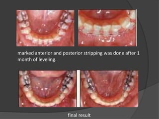 marked anterior and posterior stripping was done after 1
month of leveling.
final result
 