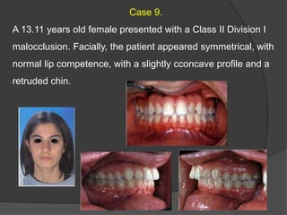Case 9.
A 13.11 years old female presented with a Class II Division I
malocclusion. Facially, the patient appeared symmetrical, with
normal lip competence, with a slightly cconcave profile and a
retruded chin.
 