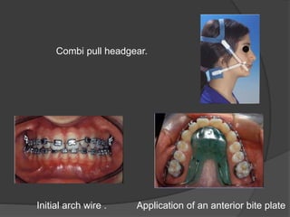 Combi pull headgear.
Initial arch wire . Application of an anterior bite plate
 