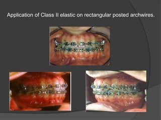 Application of Class II elastic on rectangular posted archwires.
 
