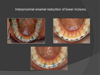 Interproximal enamel reduction of lower incisors.
 