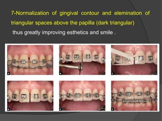 7-Normalization of gingival contour and elemination of
triangular spaces above the papilla (dark triangular)
thus greatly improving esthetics and smile .
 