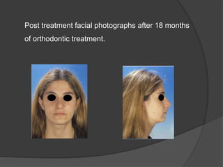 Post treatment facial photographs after 18 months
of orthodontic treatment.
 