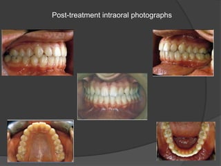 Post-treatment intraoral photographs
 