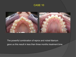 The powerful combination of reprox and nickel titanium
gave us this result in less than three months treatment time.
CASE 10
 