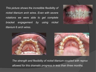 This picture shows the incredible flexibility of
nickel titanium arch wires. Even with severe
rotations we were able to get complete
bracket engagement by using nickel
titanium 6 arch wires.
The strength and flexibility of nickel titanium coupled with reprox
allowed for this dramatic progress in less than three months.
 
